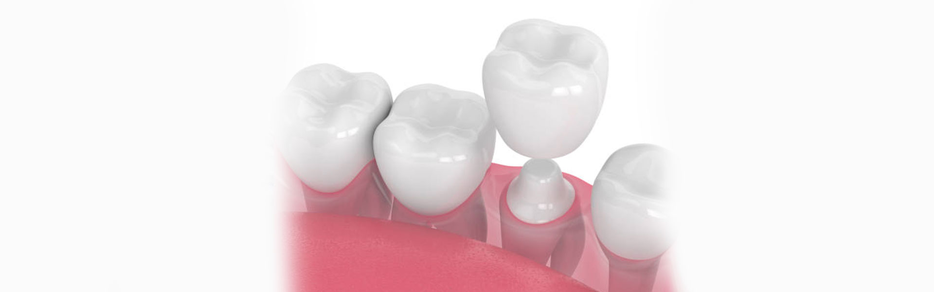 When and Why Dental Crowns Are Recommended?