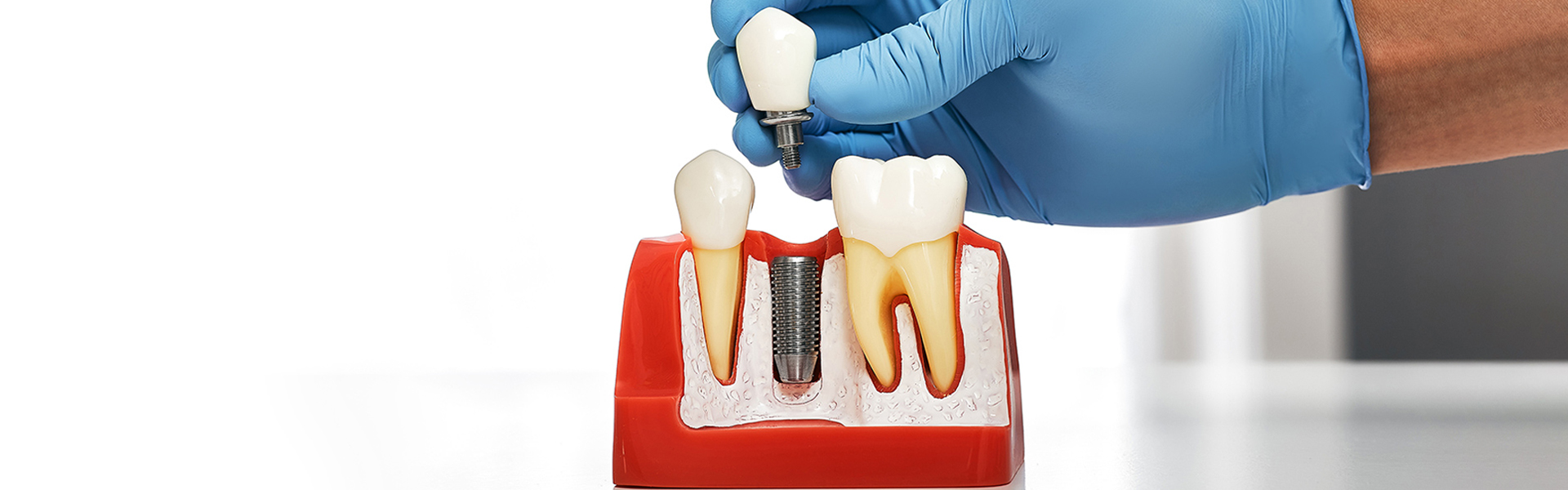 How Long Do Dental Implants Last?